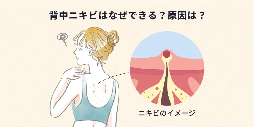 背中ニキビはなぜできる?原因は?背中ニキビのイメージ画像