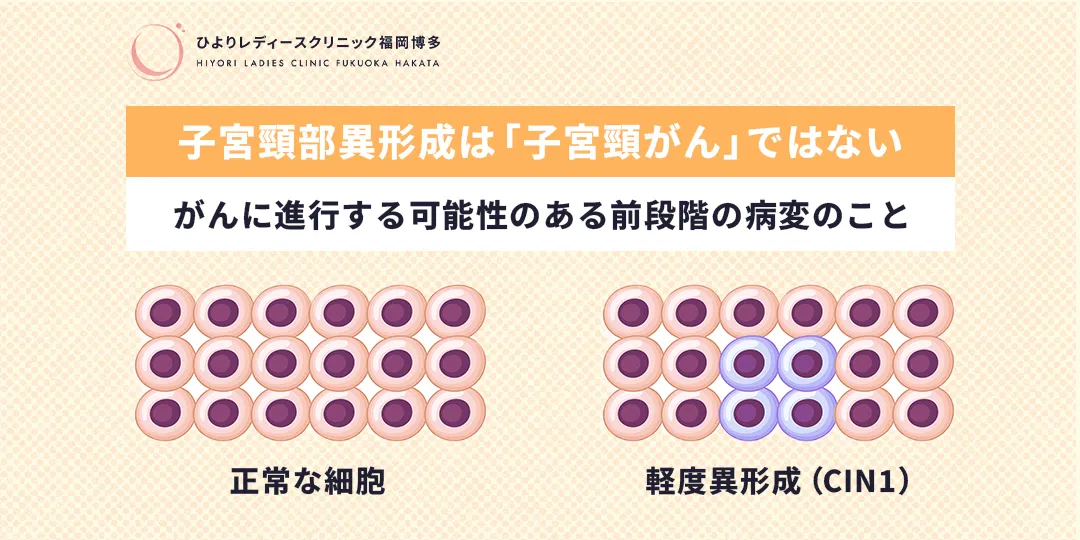 子宮頸部異形成は「子宮頸がん」ではない｜ひよりレディースクリニック福岡博多