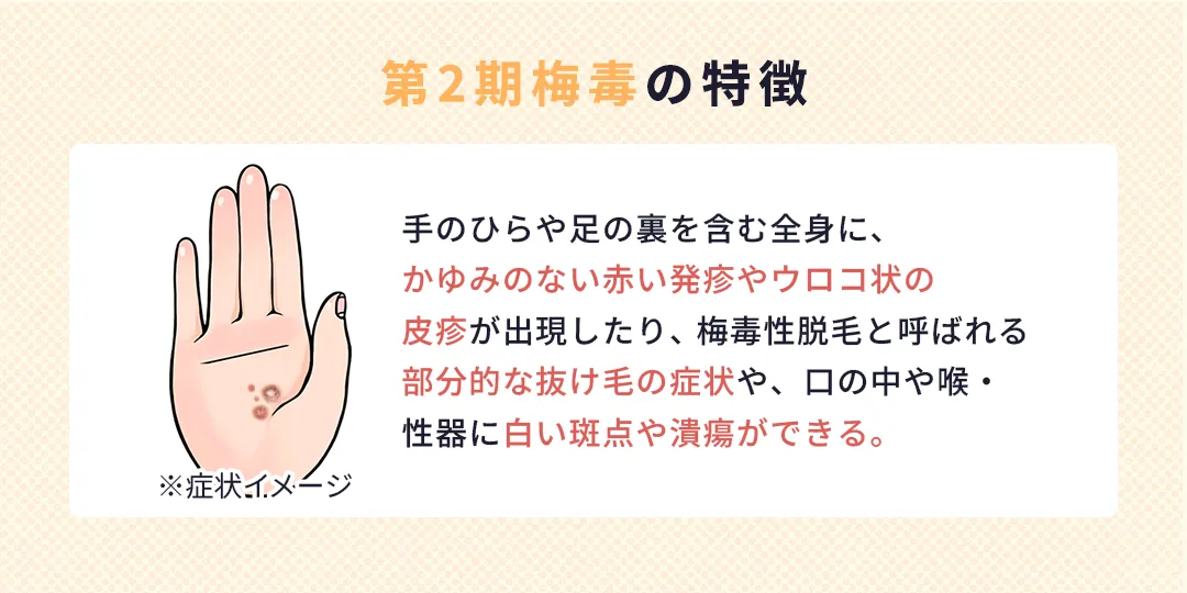 第2期梅毒の特徴|ひよりレディースクリニック福岡博多