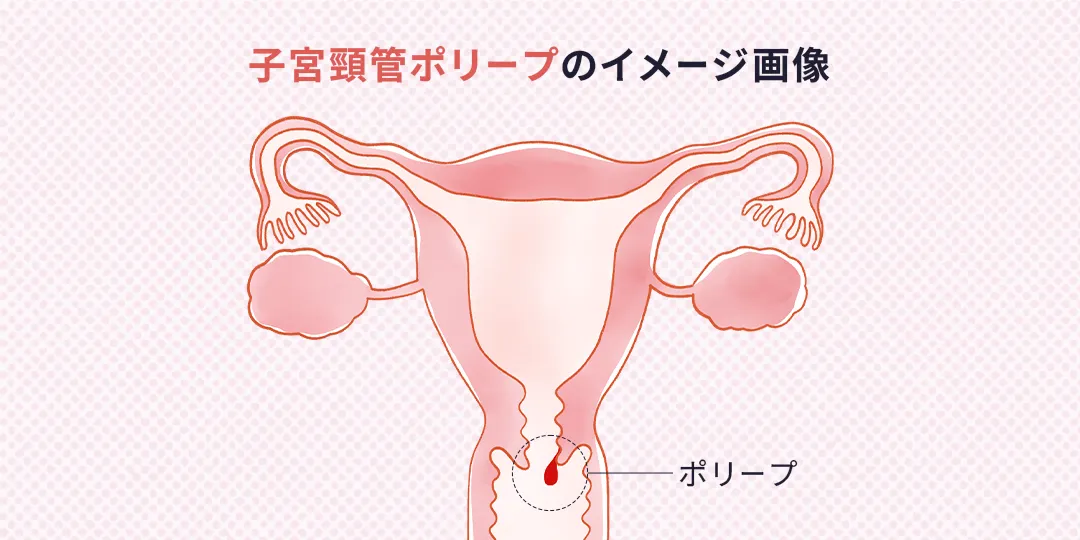 子宮頸管ポリープのイメージ画像