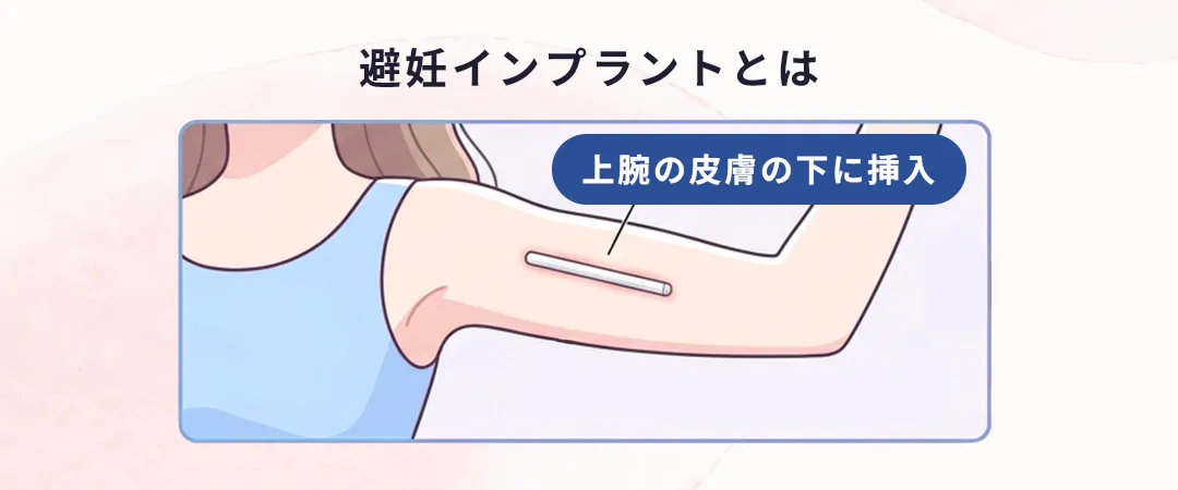 避妊インプラントとは