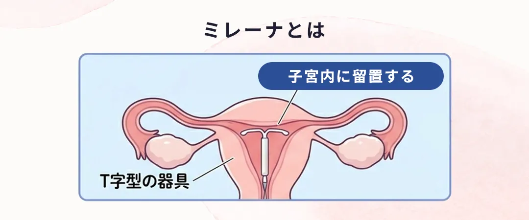 ミレーナとは