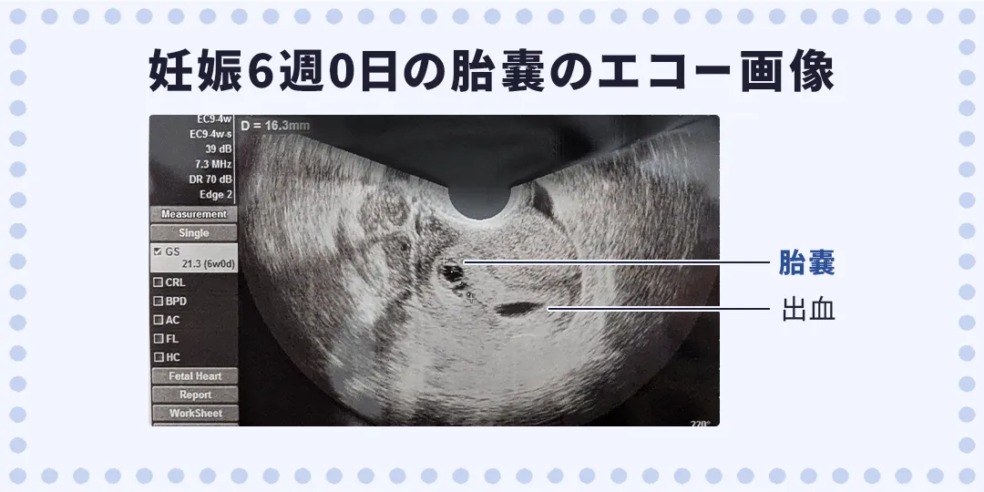 妊娠6週0日の胎嚢のエコー画像|ひよりレディースクリニック福岡博多