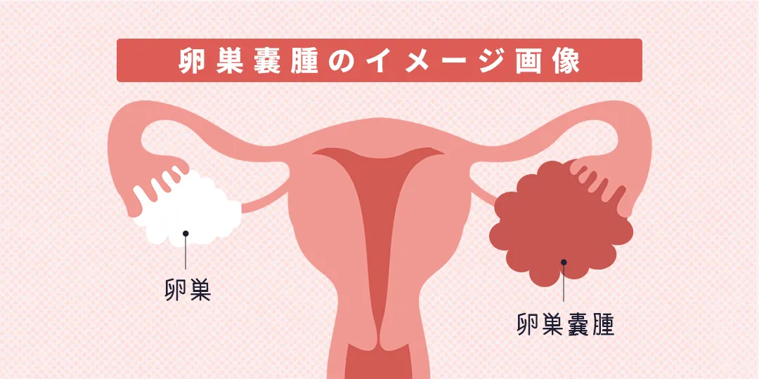 卵巣嚢腫（らんそうのうしゅ）とは|ひよりレディースクリニック福岡博多