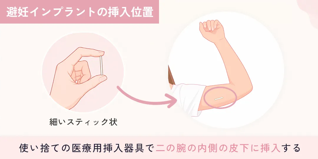 避妊インプラント挿入位置