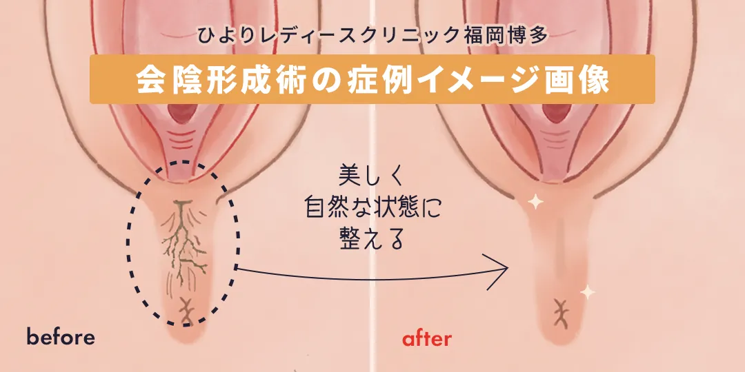 会陰形成術の症例イメージ画像|ひよりレディースクリニック福岡博多