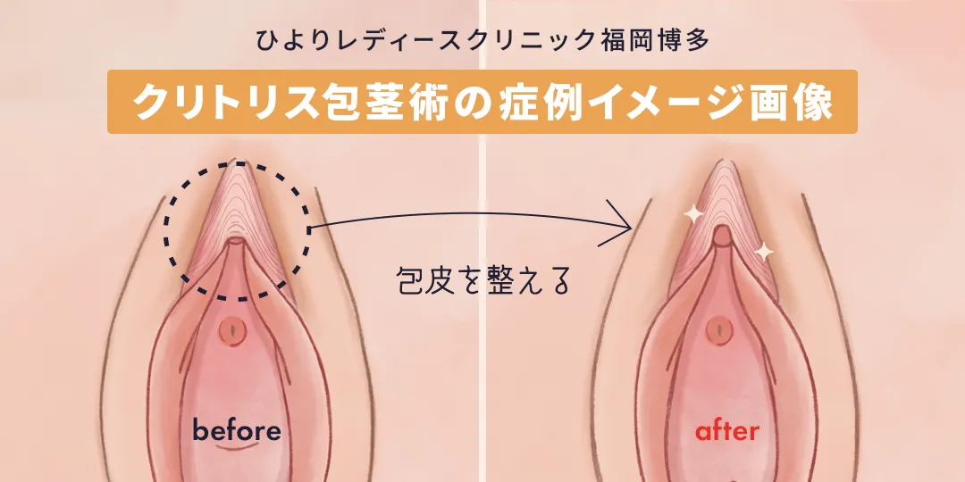 クリトリス包茎術の症例イメージ画像|ひよりレディースクリニック福岡博多