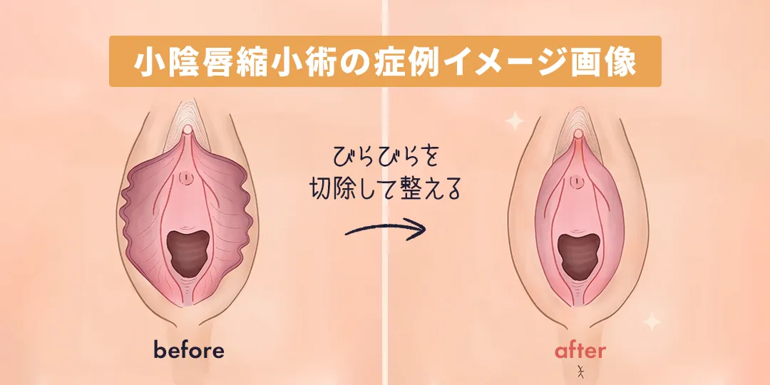 小陰唇縮小術の症例イメージ画像