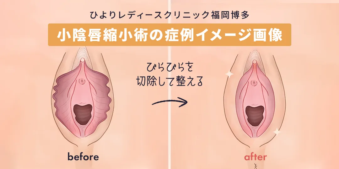 小陰唇縮小術の症例イメージ画像|ひよりレディースクリニック福岡博多