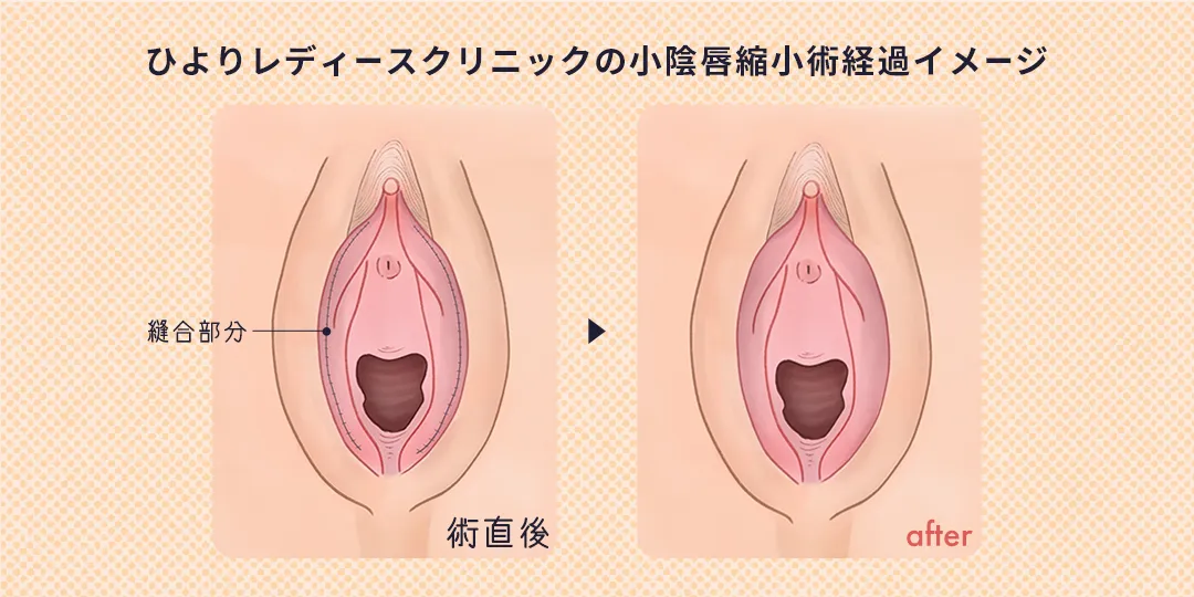 ひよりレディースクリニックの小陰唇縮小術経過イメージ