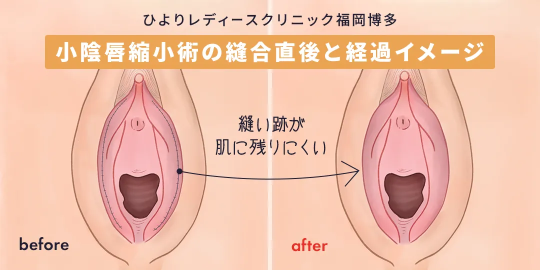 ひよりレディースクリニックの小陰唇縮小術経過イメージ