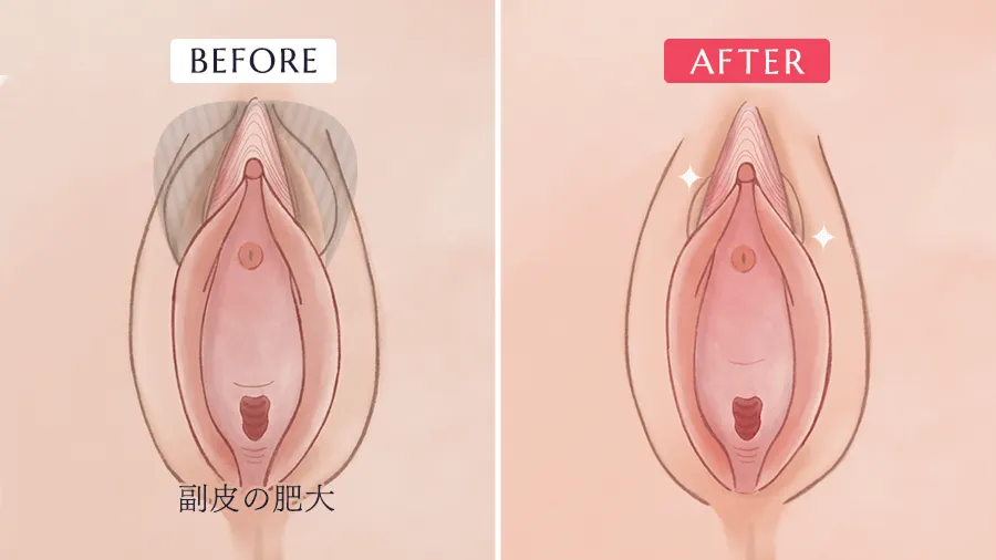 副皮切除術
