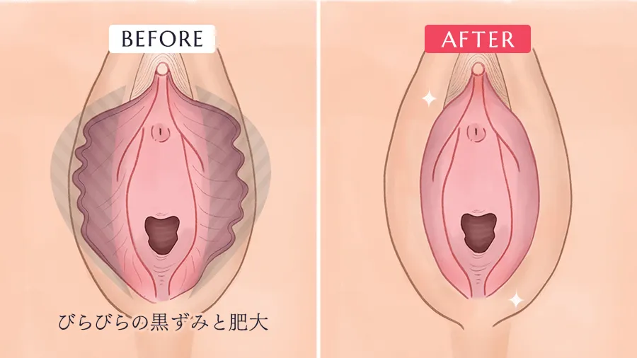 小陰唇縮小術