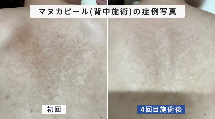 マヌカピール（背中）症例写真